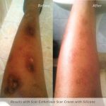 scar-esthetique-before-and-after-leg-burn-scar