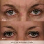 rejuvaskin-anti-aging-before-and-after