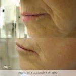 rejuvaskin-anti-aging-before-and-after-photo