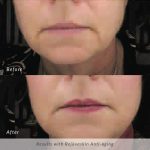 rejuvaskin-before-and-after-anti-aging