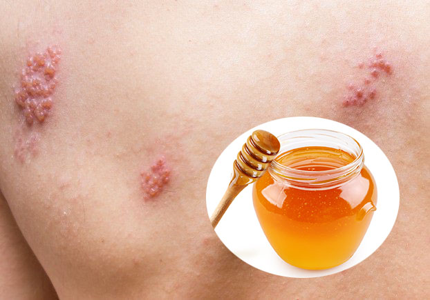 Cách chữa giời leo bằng mật ong nhanh nhất không để lại sẹo