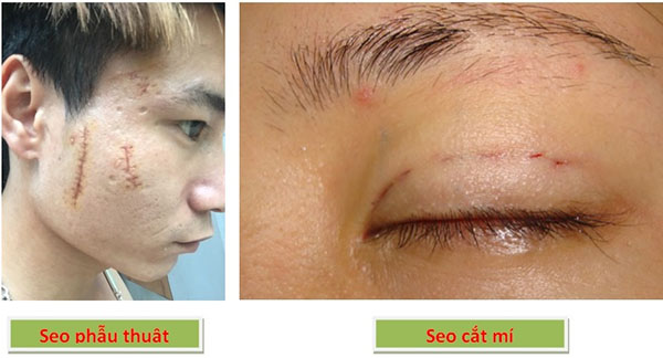 Scar Esthetique - Trị sẹo sau cắt mí, phẫu thuật Hiệu quả sản phẩm thông qua người sử dụng